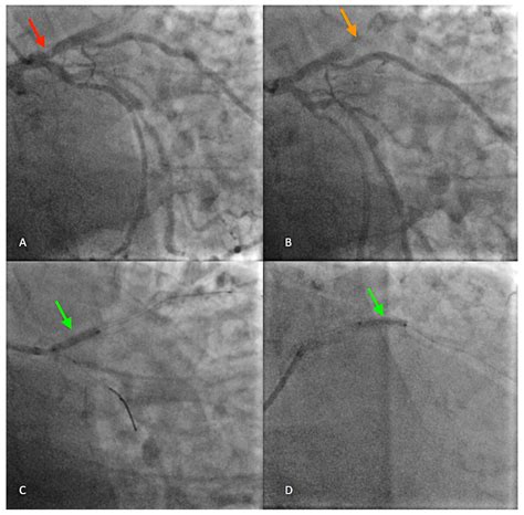 The Role of CT Imaging in a Fractured Coronary Stent with ...