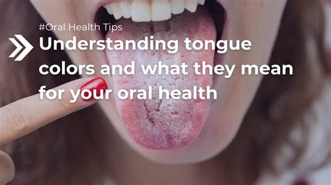 Understanding tongue colors and what they mean for your oral health