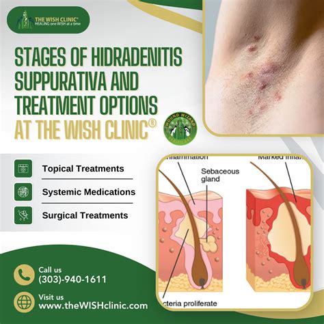 How to Manage Hidradenitis Suppurativa: Medical and Lifestyle Treatments Explained ...
