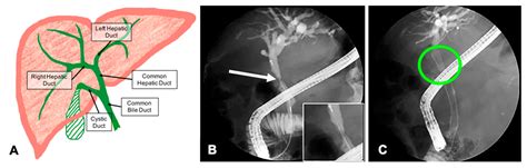 3D Printed Model of Extrahepatic Biliary Ducts for Biliary Stent Testing