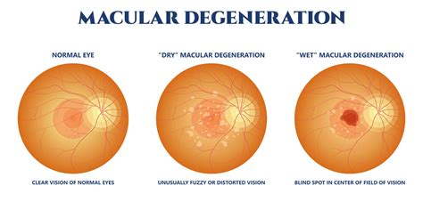 Image result for Macular Degeneration Example