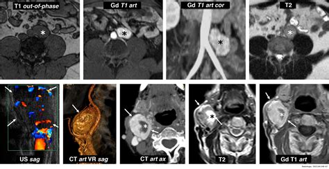 Adrenal pheochromocytoma: Keys to radiologic diagnosis | Radiología ...