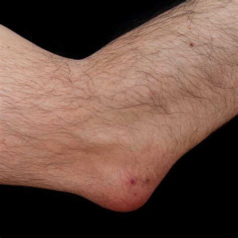 OLECRANON BURSITIS TREATMENT | Shoulder & Elbow Surgeon