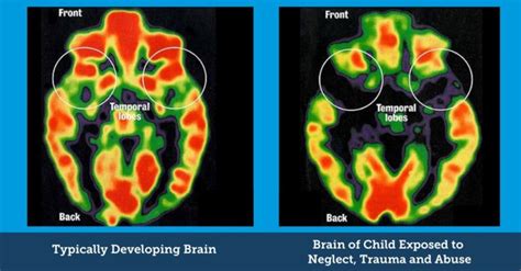 Image result for Trauma Brain Development
