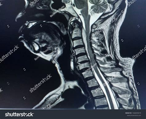 Mri Cervical Spine Neck Pain