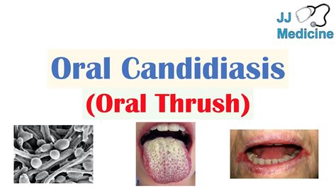 Oral Candidiasis (Oral Thrush) | Causes, Pathophysiology, Signs ...