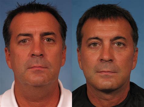 Brow Lift Before and After Pictures Case 208 | Naples and Ft. Myers, FL | Kent V. Hasen, MD ...