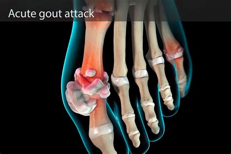 What is Gouty-Arthritis? | Inflammation Academy