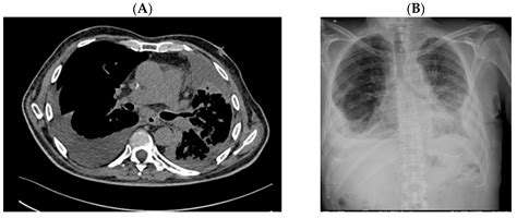 Unusual Clinical Experience in BRAF Exon 15 p.K601E-Mutated Lung Cancer ...