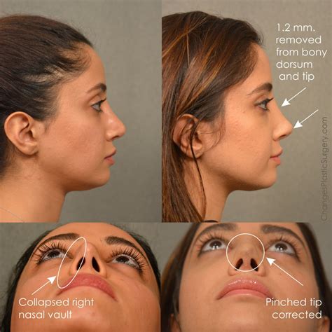 Revision rhinoplasty corrections to dorsum and collapsed right nostril. #rhinoplasty # ...