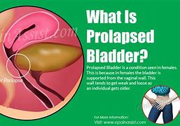 Image result for prolapsed