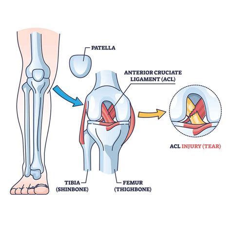 Signs Of Acl