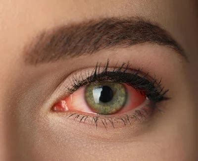 Itone Eye Drops: Solution for Eye Relaxation & Red Eye Relief