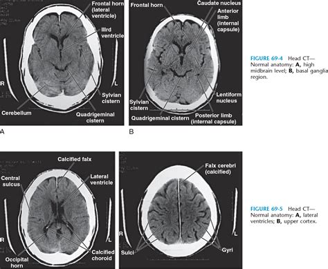Normal Brain Ct Anatomy