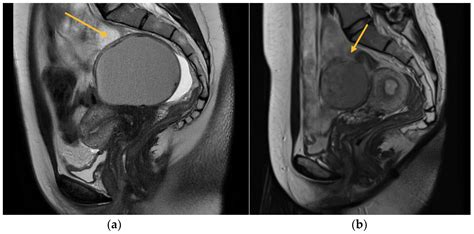 Transvaginal Ultrasound vs. Magnetic Resonance Imaging: What Is the ...