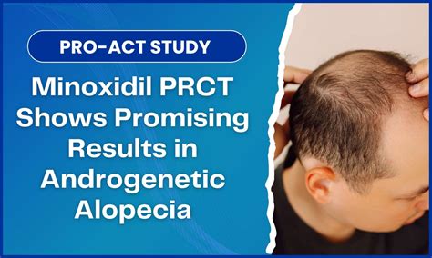 PRO-ACT Study Shows Better Outcomes with Minoxidil PRCT for ...