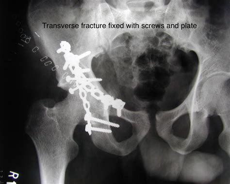 Transverse Fracture Treatment | Transverse Bone Surgery