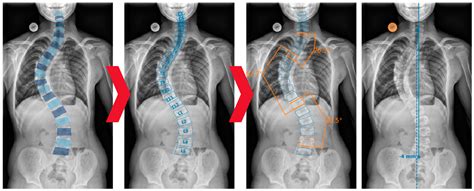 Fully Automated Measurement of Cobb Angles in Coronal Plane Spine ...