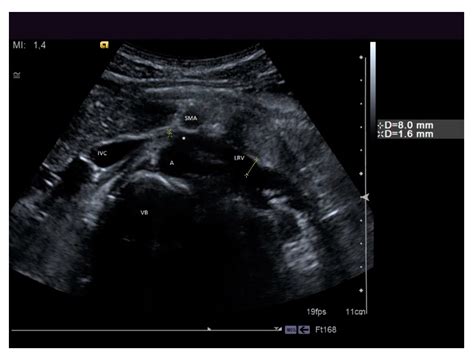 From Nutcracker Phenomenon to Nutcracker Syndrome: A Pictorial Review