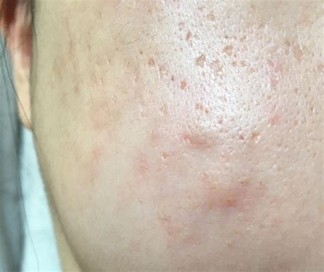 Acne Scar Bumps Under Skin at Tatum Mathis blog