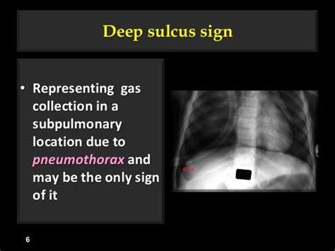 Image result for Negative Sulcus Sign