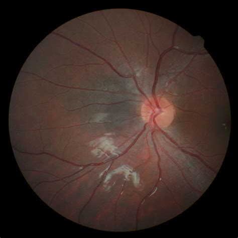 Choroidal Melanoma - Eye Life Vision Center