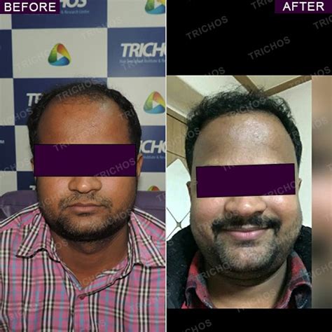 Trichos | Best Hair Treatment in Hyderabad | Dr John Watts