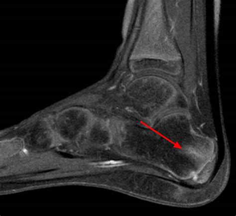 Heel pain causes, symptoms, diagnosis, pain relief & heel pain treatment