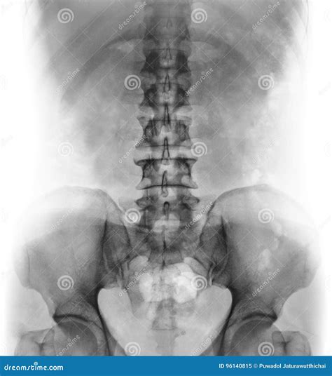 What Does A Normal Lumbar X-Ray Look Like at Lauren Fosbery blog