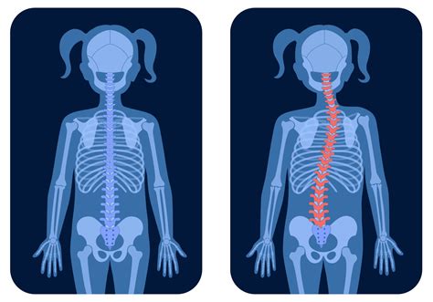 Scoliosis Awareness Day - Newcastle Hospitals NHS Foundation Trust