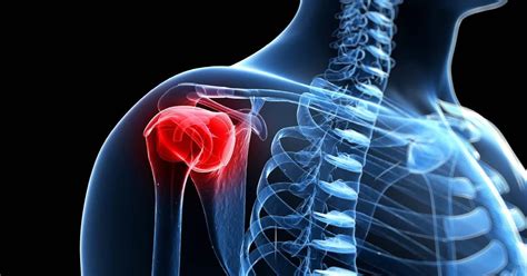Image result for Subacromial Decompression Rotator Cuff Repair