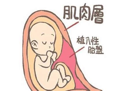 第一胎是前置胎盘，生第二胎，会不会遗传