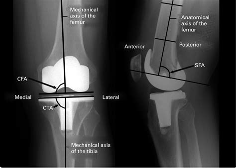 The evaluation of post-operative alignment in total knee replacement using a CT-based navigation ...