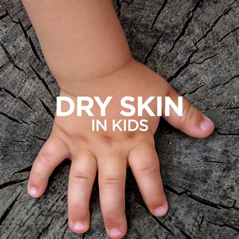 Dry Skin in Kids – Soulflower.in