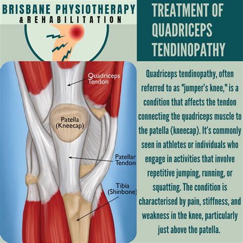 Quadriceps Tendon Pain Treatment Anterior Cruciate Ligament Revision