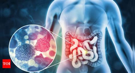 As GI cancers rise in Goa, docs stress on need for increased screening ...