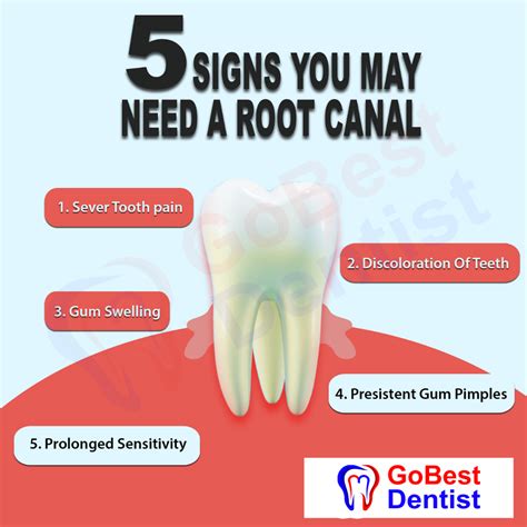 Root-Cannal-Treatment - Gobest Dentist