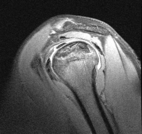 Avascular Necrosis - Causes, Symptoms, Prevention & Treatment