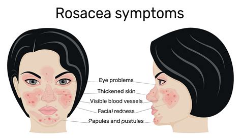 What Causes Itchy Rosacea And How To Soothe It - SL Aesthetic Clinic
