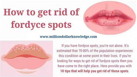 Fordyce Spots In Vulva