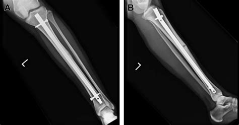 Famous Athletes With Stress Fractures at Patricia Petrie blog