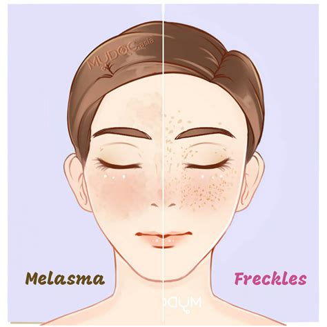 Melanoma Vs Freckle at Matthew Wetzel blog