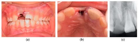Severe Case of Delayed Replantation of Avulsed Permanent Central ...