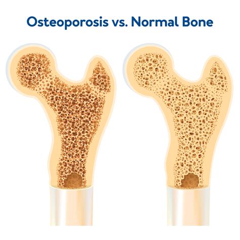 Osteopenia Vs Osteoporosis