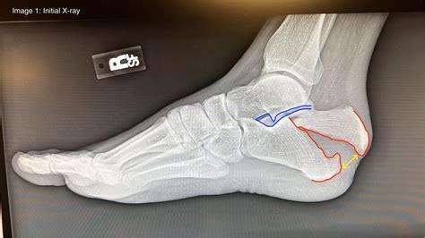 Calcaneus