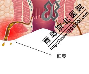 治肛瘘的有效方法 青岛京北分析最详尽－青岛新闻网