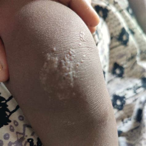 my kid has this type of pimples on his elbow,knees, fingers etc what to do ? treatment for this ...