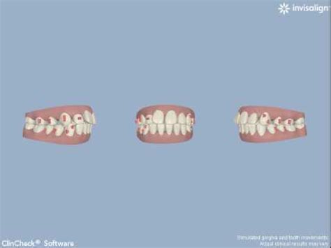 Invisalign Animation 的图像结果