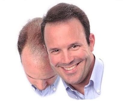 Best Aesthetic Hair Grow Treatment In Ahmedabad