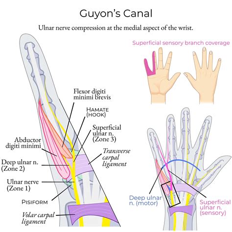 Guyon's Canal Syndrome